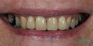 Tooth coloured fillings