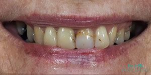 Tooth coloured fillings