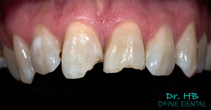 Composite-2.1