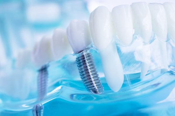 Dental Implants | North Rocky Dental