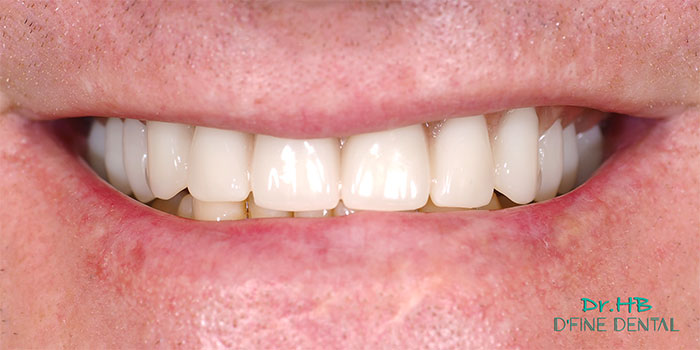 Denture-replace-1.2