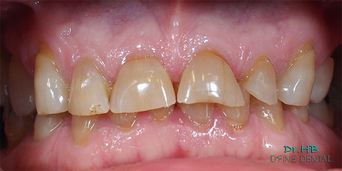Full-mouth-1.1