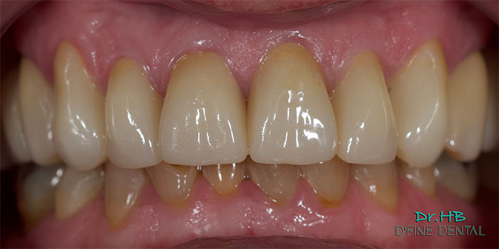 Full-mouth-1.2