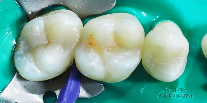 Tooth coloured fillings