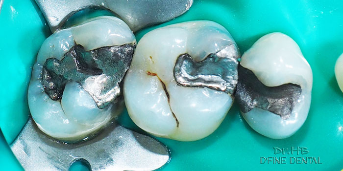 Tooth coloured fillings