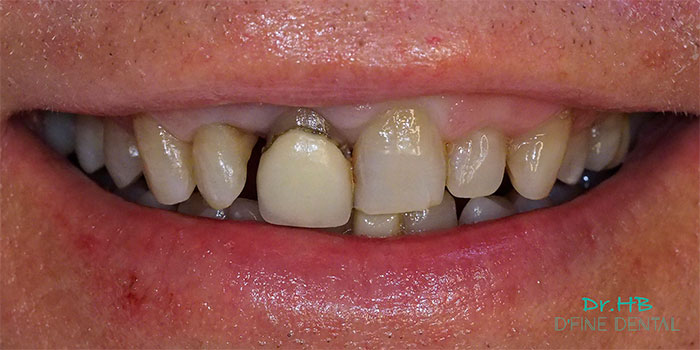 crown-replace-2.1