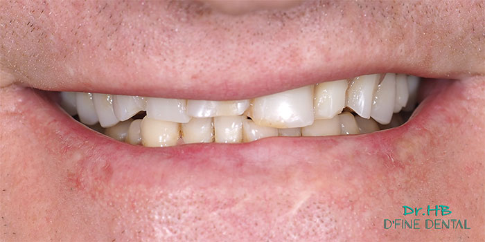 denture-replace-1.1
