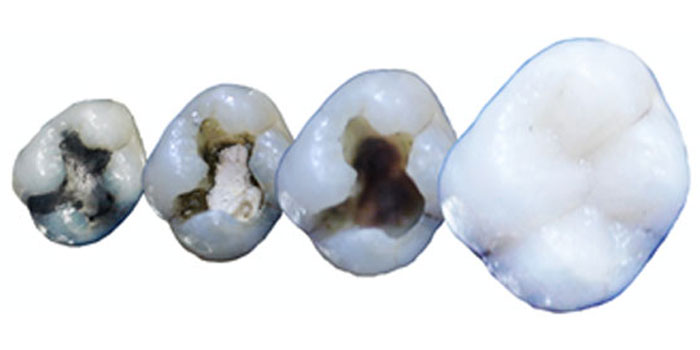 Tooth coloured fillings