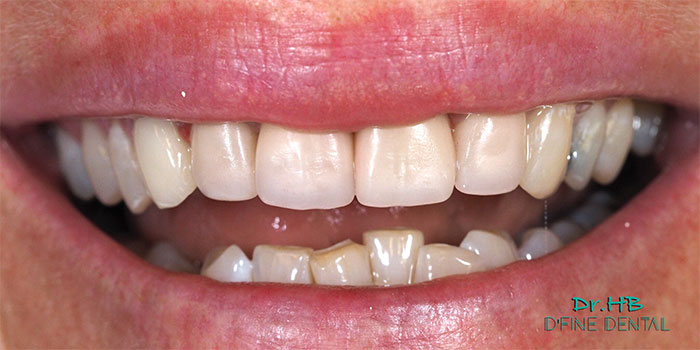 smile-design-2.2