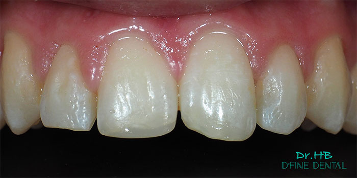 smile-design-composite