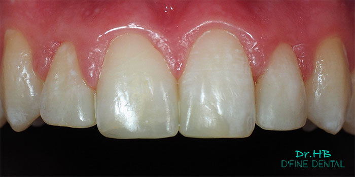 smile-design-composite