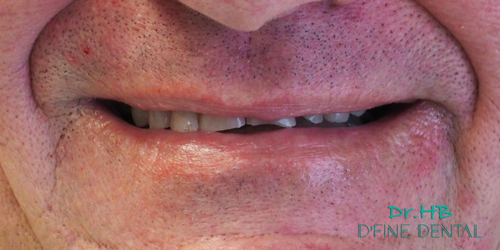 Full-mouth-smile