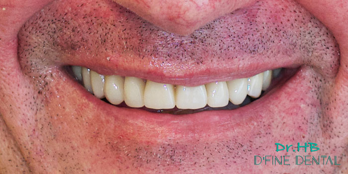 Full-mouth-smile
