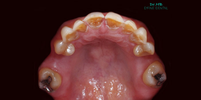 occlusal-rehab