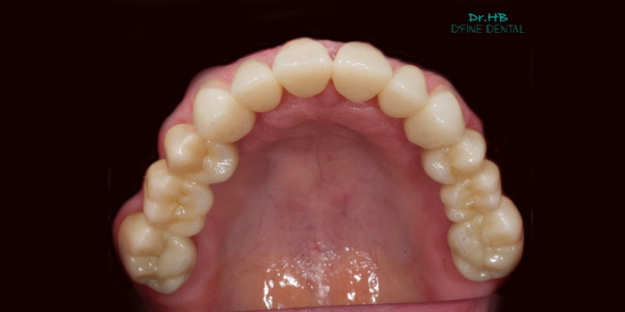 occlusal-rehab