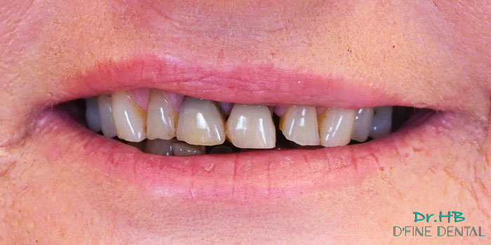 smile-makeover