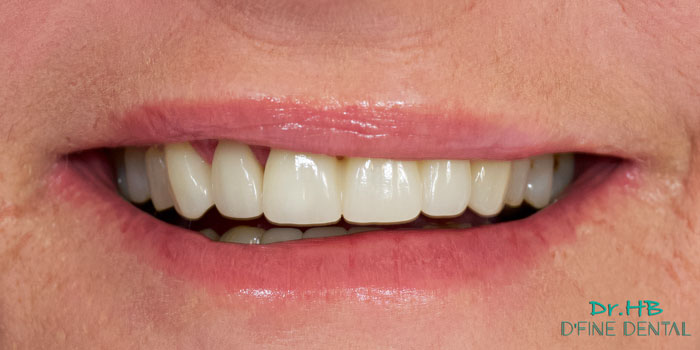 smile-makeover