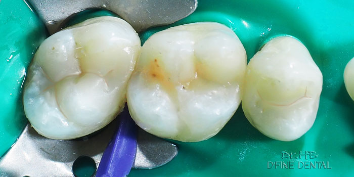 Amalgum filling after