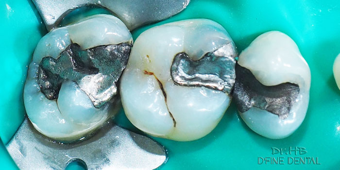 Amalgum filling before picture