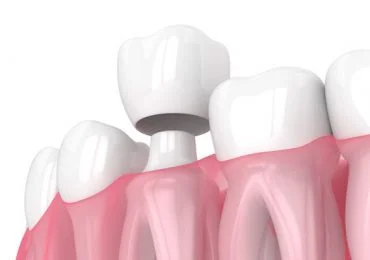 Render-Of-Jaw-With-Teeth-An-370x260