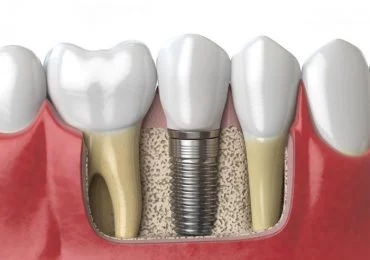dental-implants-370x260
